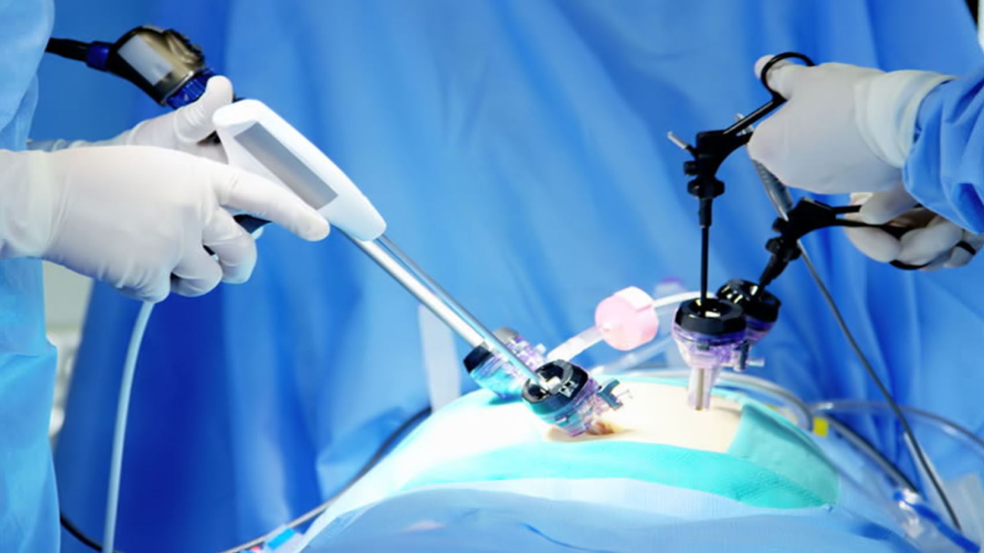 Лапароскопический метод