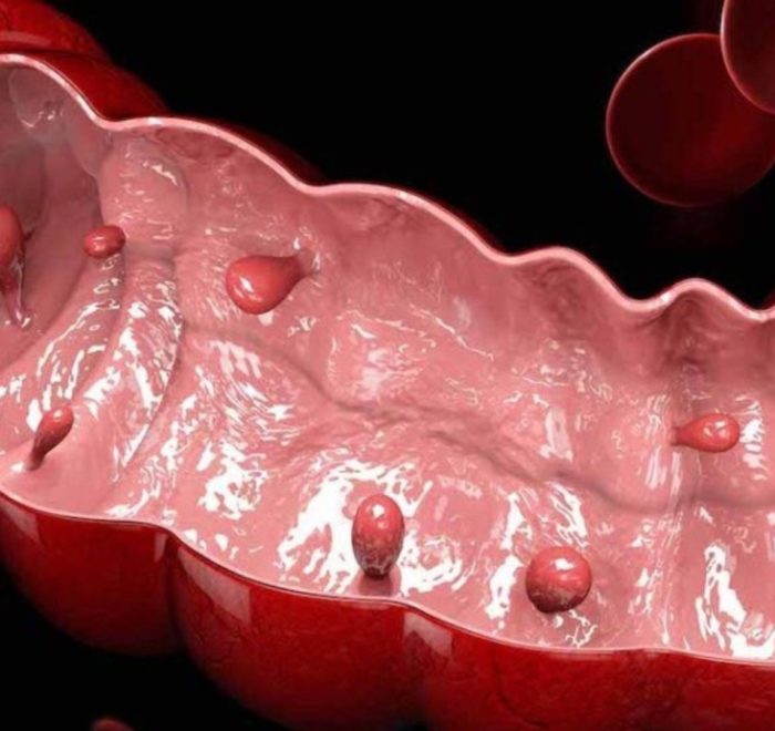 Полипы толстой кишки