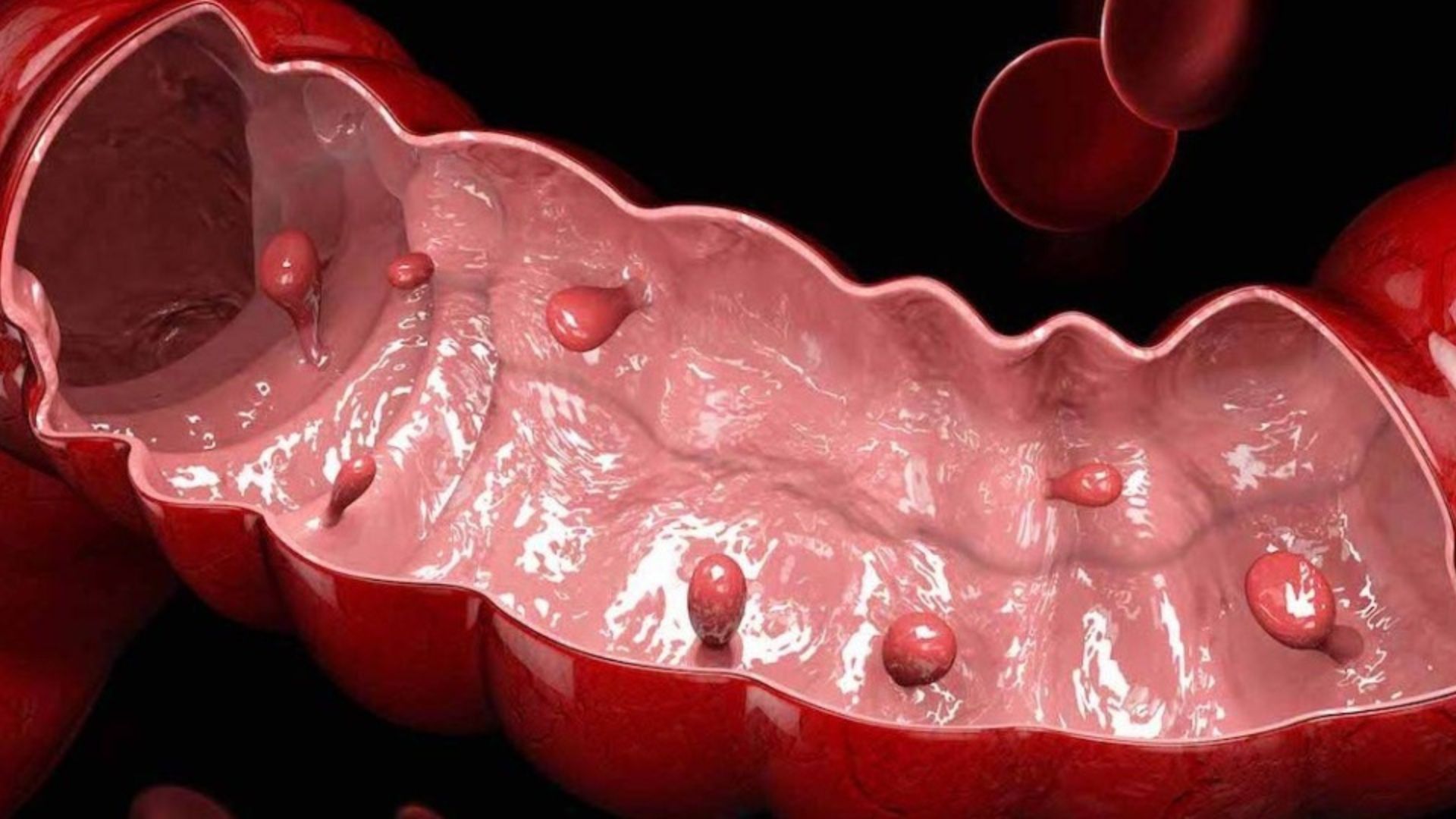 Полипы толстой кишки