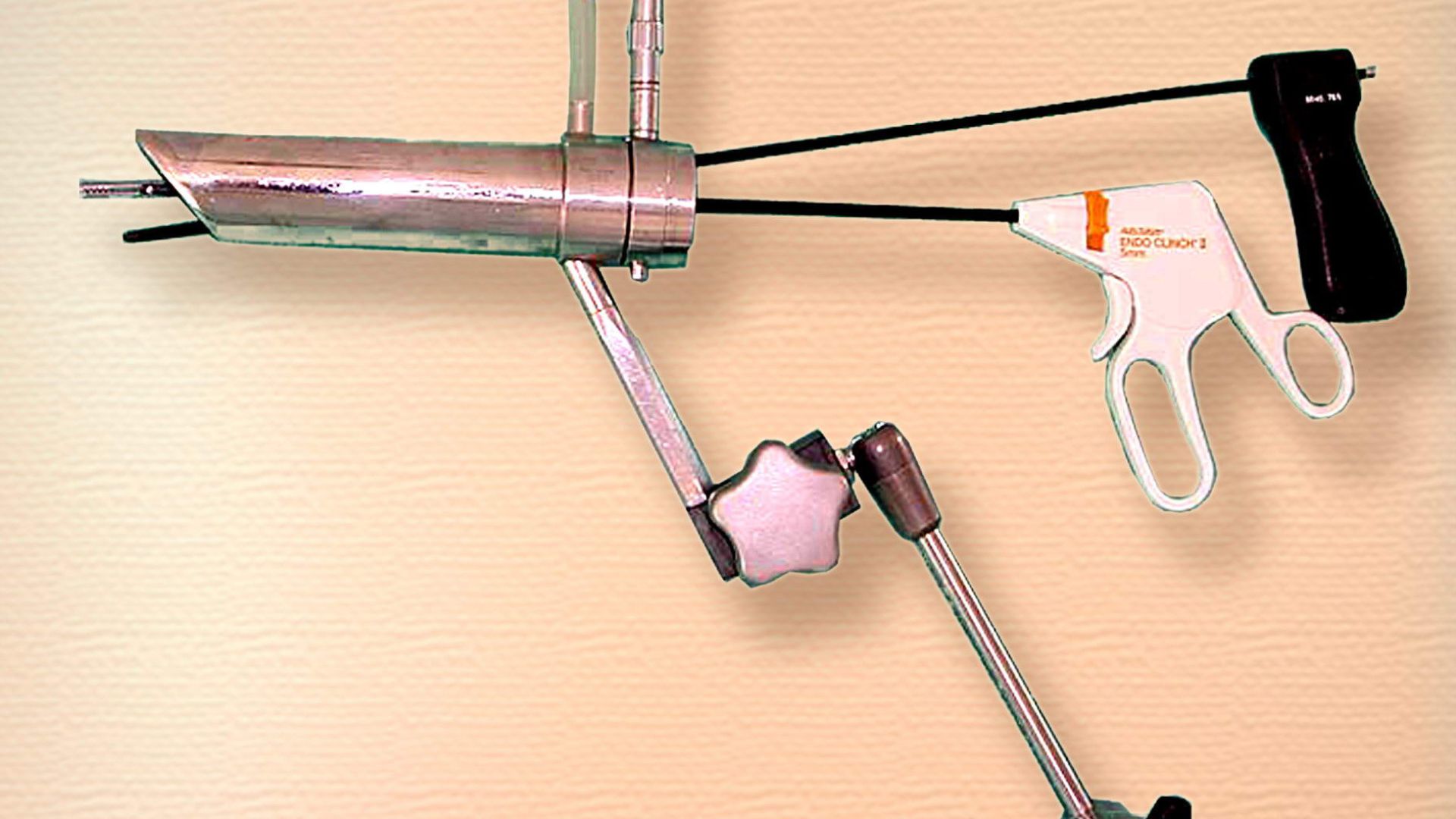 Трансанальное эндомикрохирургическое удаление опухоли