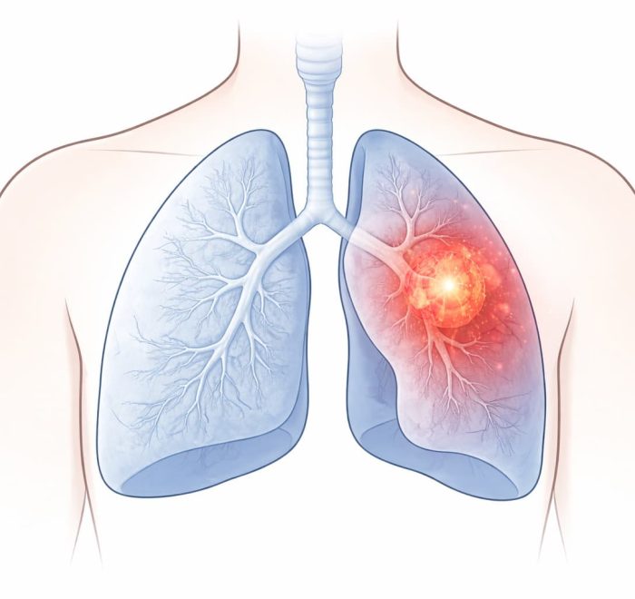Рак легких