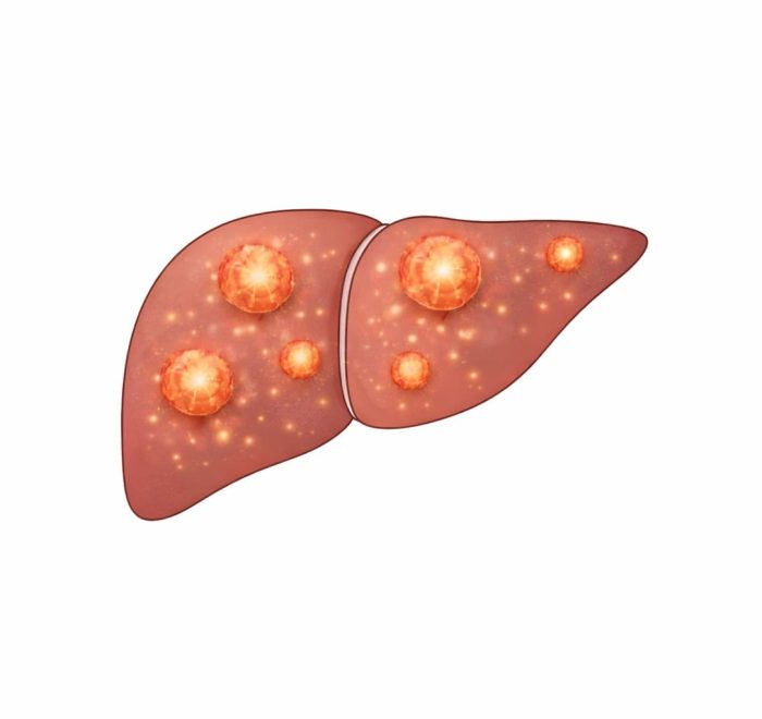 Рак печени
